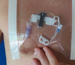 BARRIER, IV PICC HYDROSEAL 9"X9" (7/PK 14PK/BX 10BX/CS)