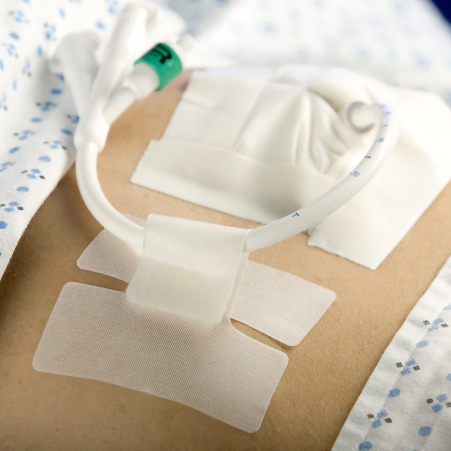Multi-Purpose Tube Securement Cath-Secure