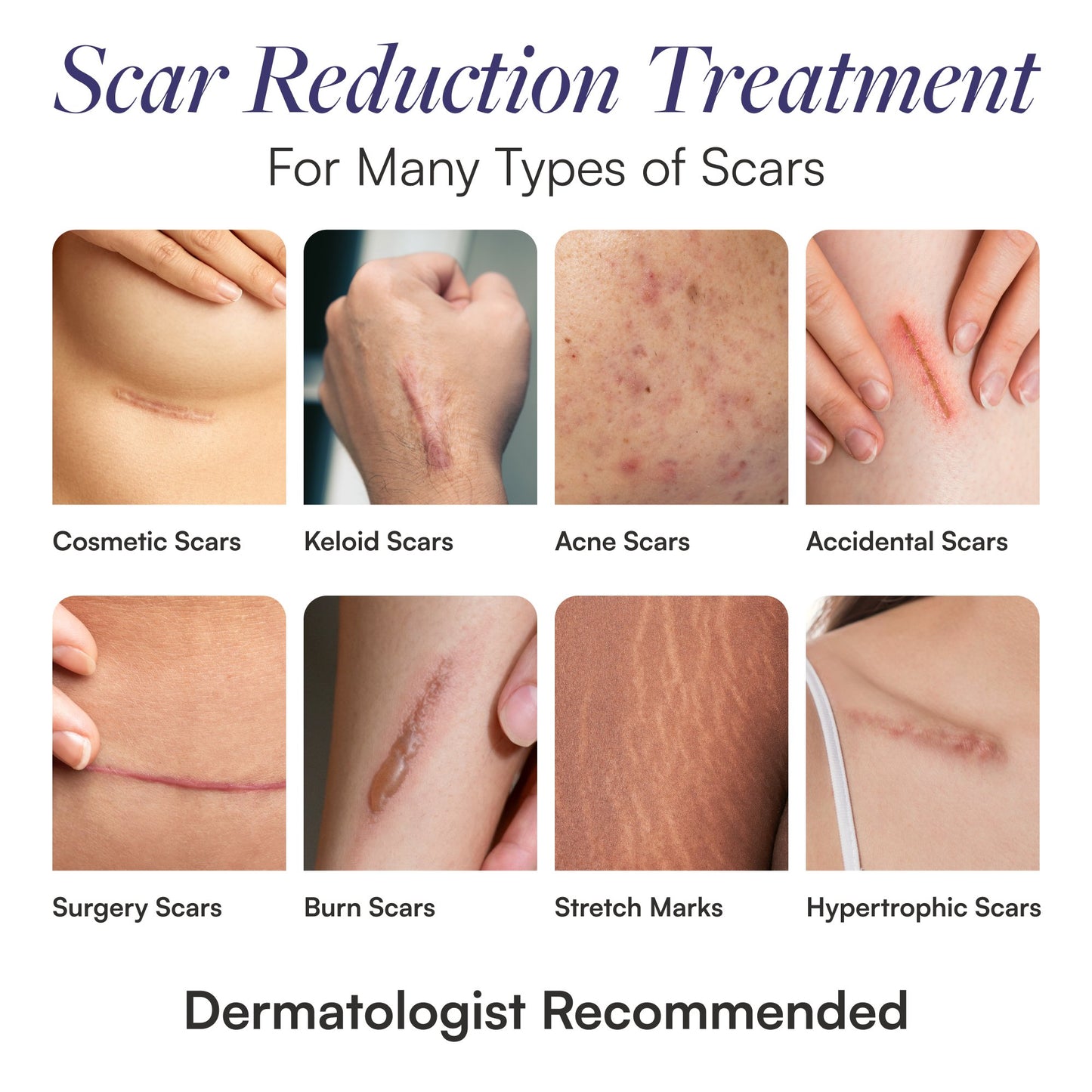 Scar Treatment Skintensive 1.5 oz. Tube Unscented Gel